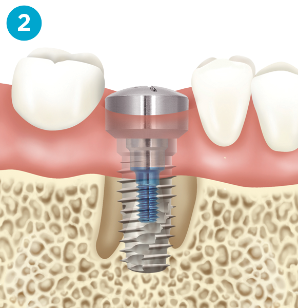 implant step one